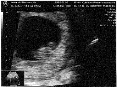Bebé de 9 semanas y 2 días de gestación